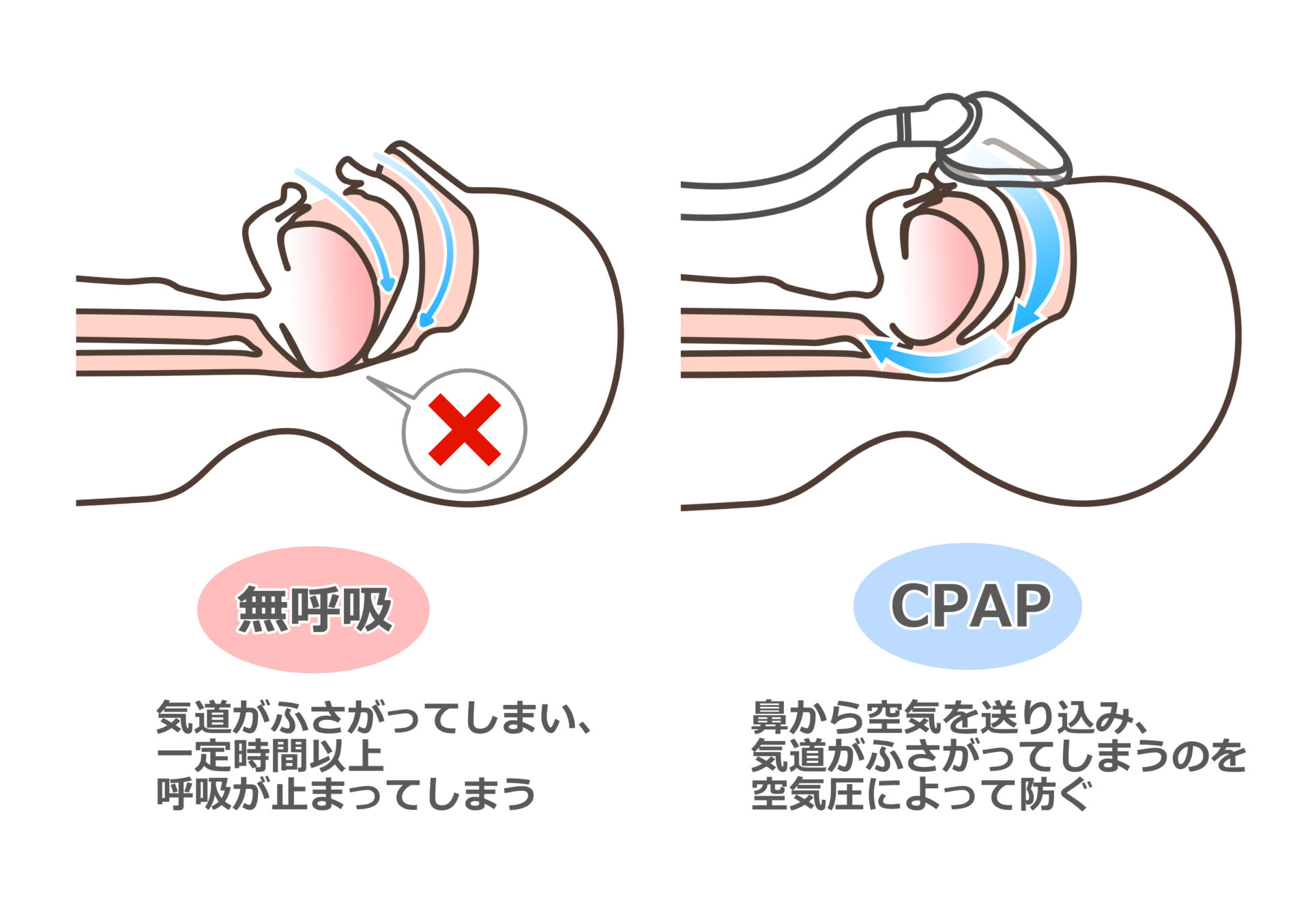 【イラスト】CPAPの図解：無呼吸では気道がふさがってしまい、一定時間以上呼吸が止まってしまう。CPAP：鼻から空気を送り込み、気道がふさがってしまうのを空気圧によって防ぐ